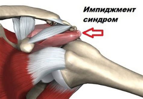 Лечение боли в правом плечевом суставе